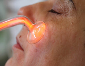 Behandlung der Gesichthaut per Kaltplasma
